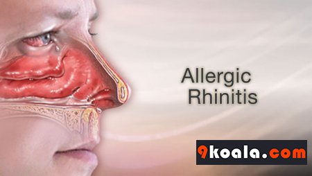 What is Allergic Rhinitis? How Is It Treated? (Allergic Flu)